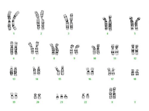 Trisomy 21