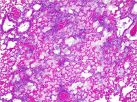 This shows a cross-section of a mouse lung infected with Pseudonomas aeruginosa. The mouse was treated with a version of Mycoplasma pneumoniae that could not produce therapeutic molecules, resulting in severe pneumoniae. This is characterised by massive infiltration of inflammatory cells into the alveolar septa, resulting in loss of air in the alveoli. Credit: Rocco Mazzolini/CRG   